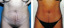 Liposuction Patient Before & After Photo 1