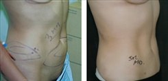 Liposuction Patient Before & After Photo 1