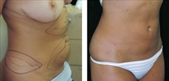 Liposuction Patient Before & After Photo 1