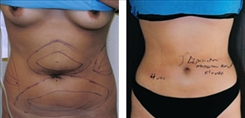 Liposuction Patient Before & After Photo 1