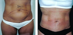 Liposuction Patient Before & After Photo 1