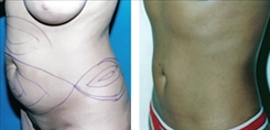 Liposuction Patient Before & After Photo 1