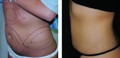 Liposuction Patient Before & After Photo 1