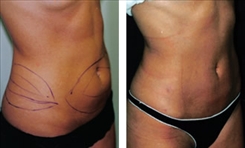 Liposuction Patient Before & After Photo 1