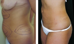 Liposuction Patient Before & After Photo 1