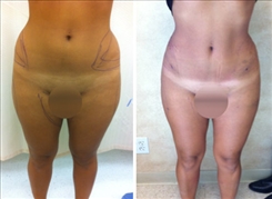 Liposuction Patient Before & After Photo 1