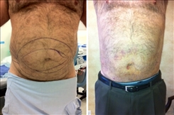 Liposuction Patient Before & After Photo 1