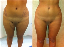 Liposuction Patient Before & After Photo 1