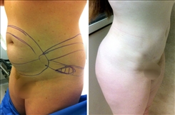 Liposuction Patient Before & After Photo 1