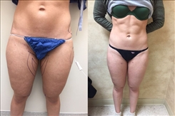 Liposuction Patient Before & After Photo 1