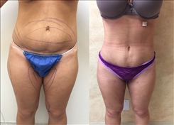 Liposuction Patient Before & After Photo 1