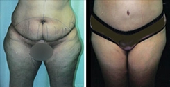 Liposuction Patient Before & After Photo 1