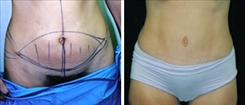 Liposuction Patient Before & After Photo 1