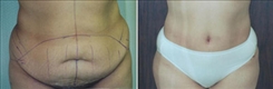 Liposuction Patient Before & After Photo 1