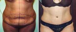 Liposuction Patient Before & After Photo 1