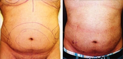 Liposuction Patient Before & After Photo 1