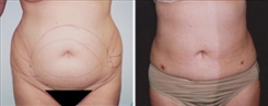 Liposuction Patient Before & After Photo 1