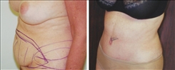 Liposuction Patient Before & After Photo 1