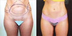 Liposuction Patient Before & After Photo 1