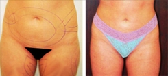 Liposuction Patient Before & After Photo 1