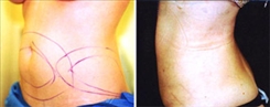 Liposuction Patient Before & After Photo 1