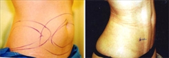 Liposuction Patient Before & After Photo 1