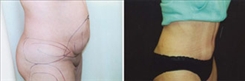 Liposuction Patient Before & After Photo 1