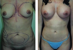 Liposuction Patient Before & After Photo 1