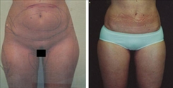 Liposuction Patient Before & After Photo 1