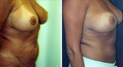 Liposuction Patient Before & After Photo 1