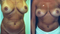 Liposuction Patient Before & After Photo 1