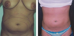 Liposuction Patient Before & After Photo 1