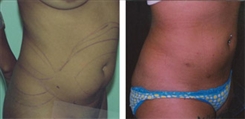 Liposuction Patient Before & After Photo 1