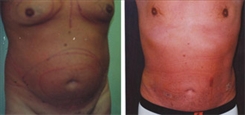 Liposuction Patient Before & After Photo 1