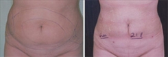 Liposuction Patient Before & After Photo 1