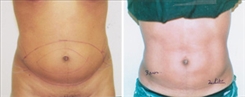 Liposuction Patient Before & After Photo 1