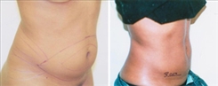 Liposuction Patient Before & After Photo 1