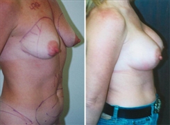 Liposuction Patient Before & After Photo 1