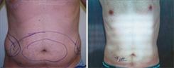 Liposuction Patient Before & After Photo 1