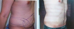 Liposuction Patient Before & After Photo 1