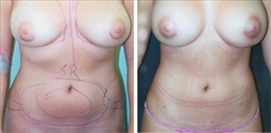 Liposuction Patient Before & After Photo 1