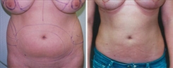 Liposuction Patient Before & After Photo 1