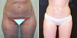 Liposuction Patient Before & After Photo 1