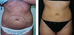 Muffin Top Patient Before & After Photo 1