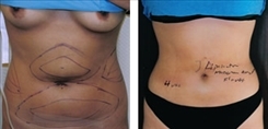 Muffin Top Patient Before & After Photo 1