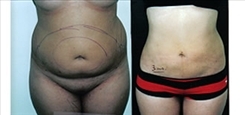 Body Procedures Patient Before & After Photo 1