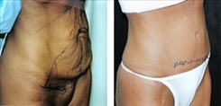 Body Procedures Patient Before & After Photo 1