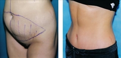 Body Procedures Patient Before & After Photo 1