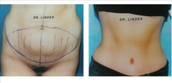 Panniculectomy Patient Before & After Photo 1