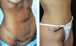 Panniculectomy Patient Before & After Photo 1